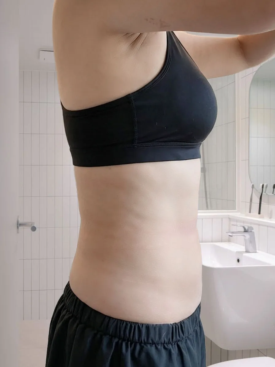 G-fat abdomen lipolysis after, G Clinic Gangnam case 01