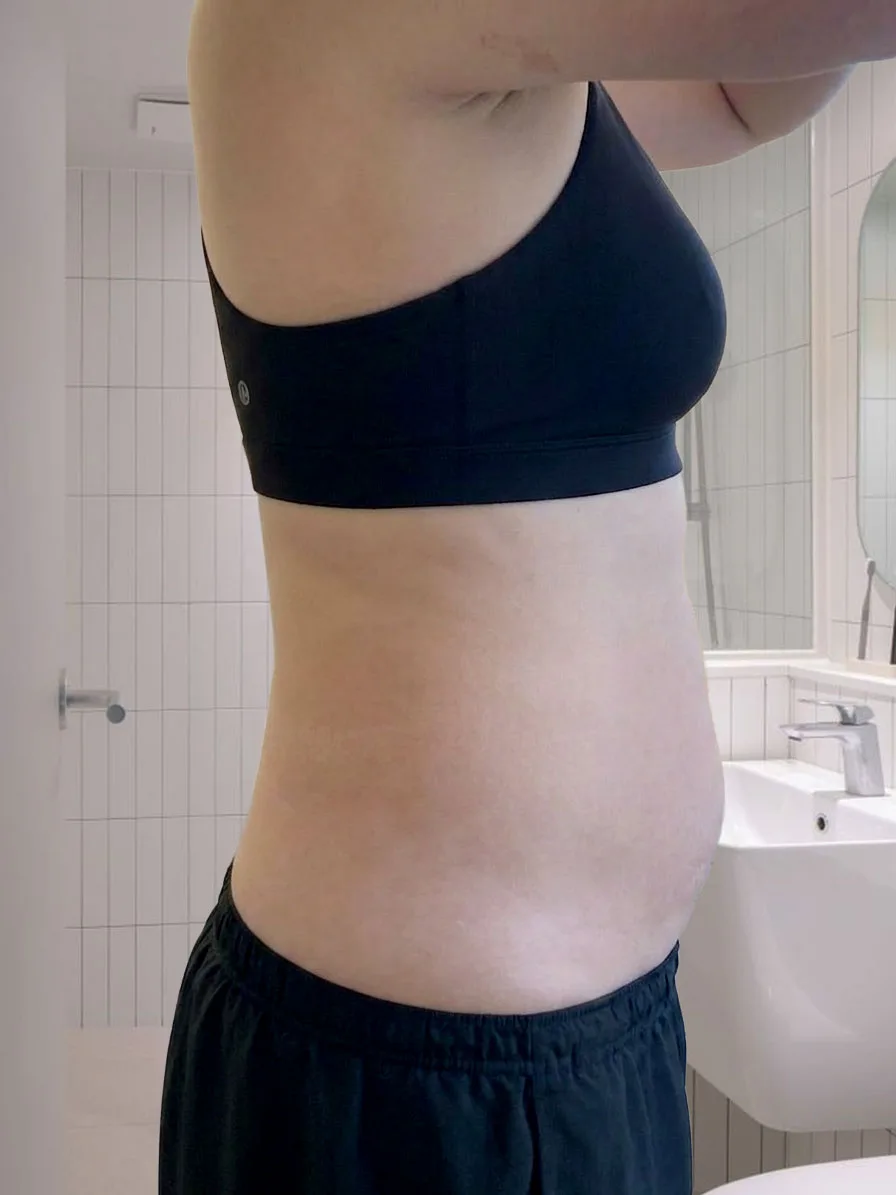 G-fat abdomen lipolysis before, G Clinic Gangnam case 01
