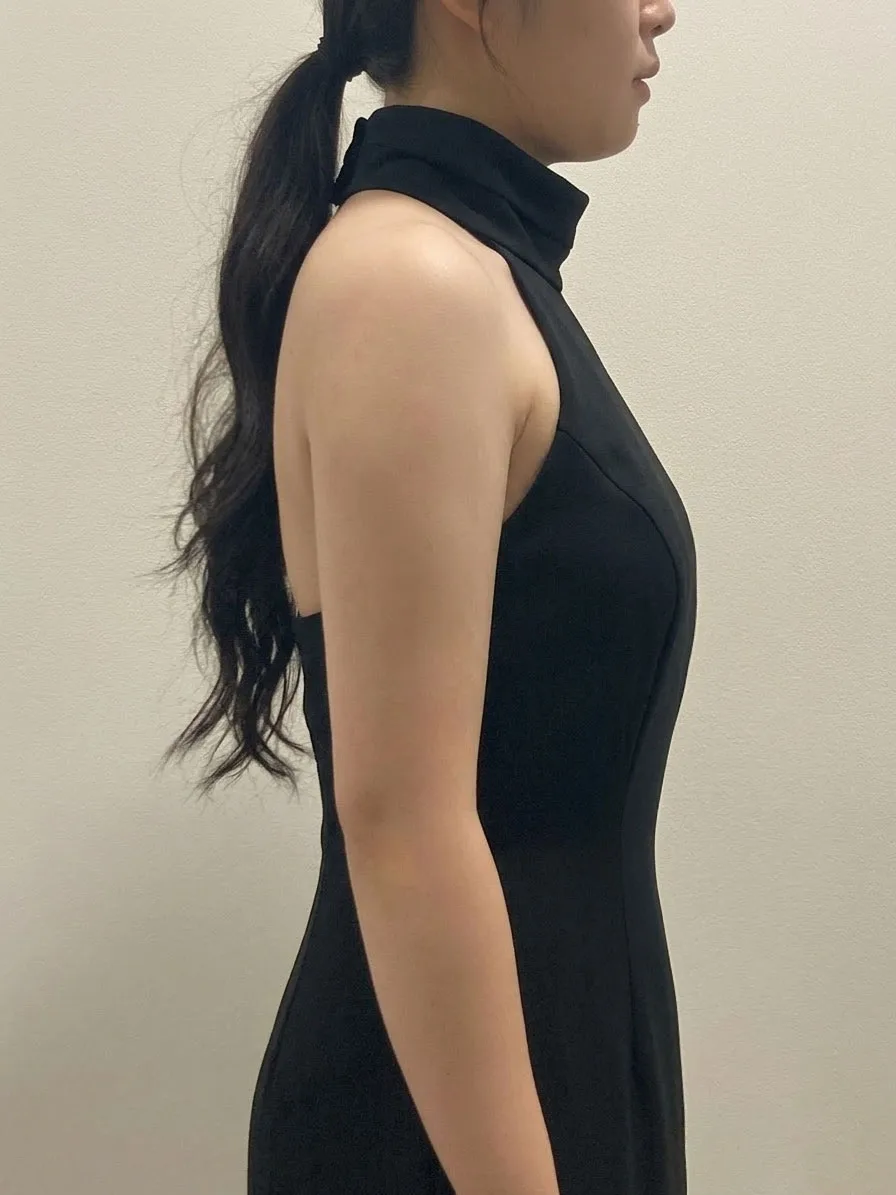 G-fat upper arm lipolysis after, G Clinic Gangnam case 02