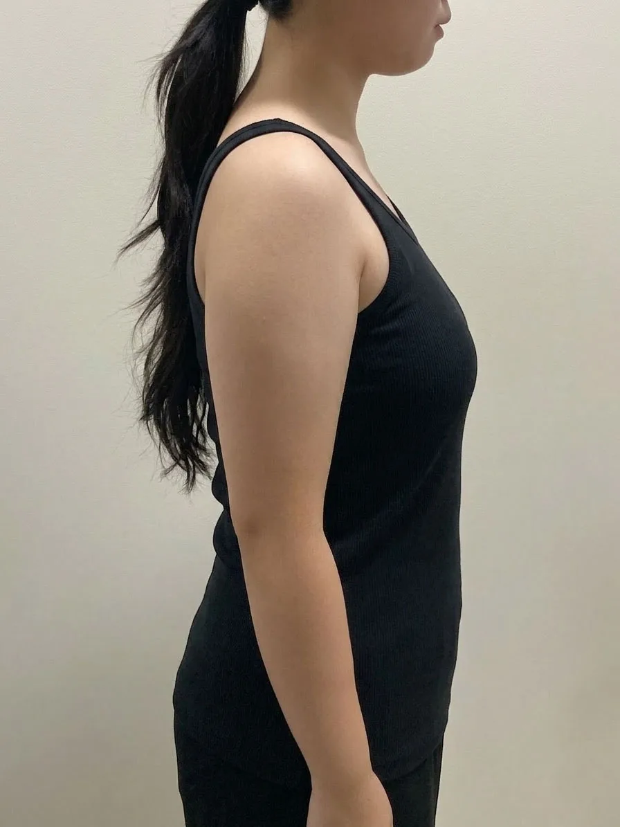 G-fat upper arm lipolysis before, G Clinic Gangnam case 02