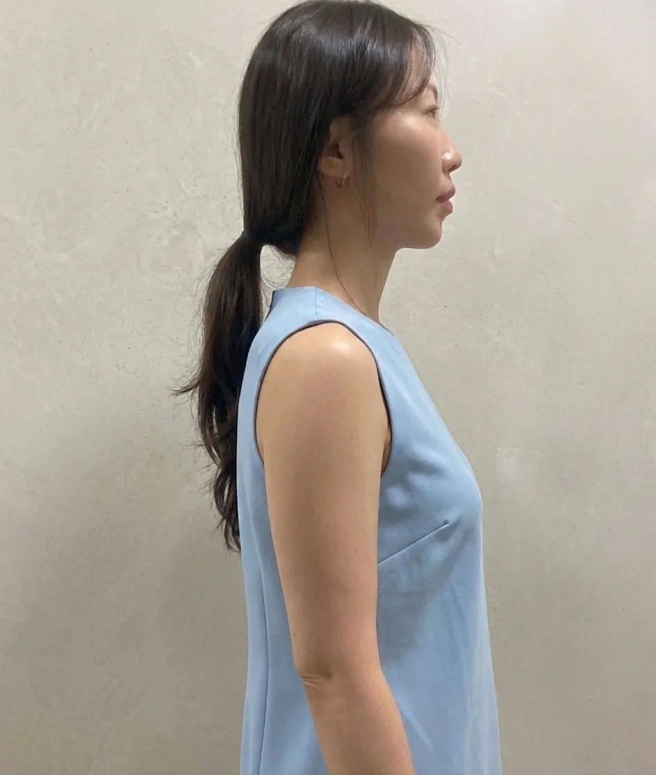 G-fat upper arm lipolysis after, G Clinic Gangnam case 05
