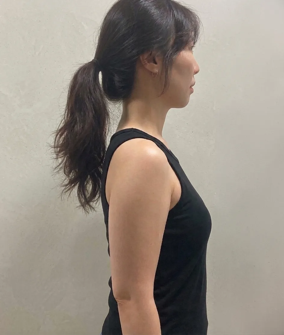 G-fat upper arm lipolysis before, G Clinic Gangnam case 05