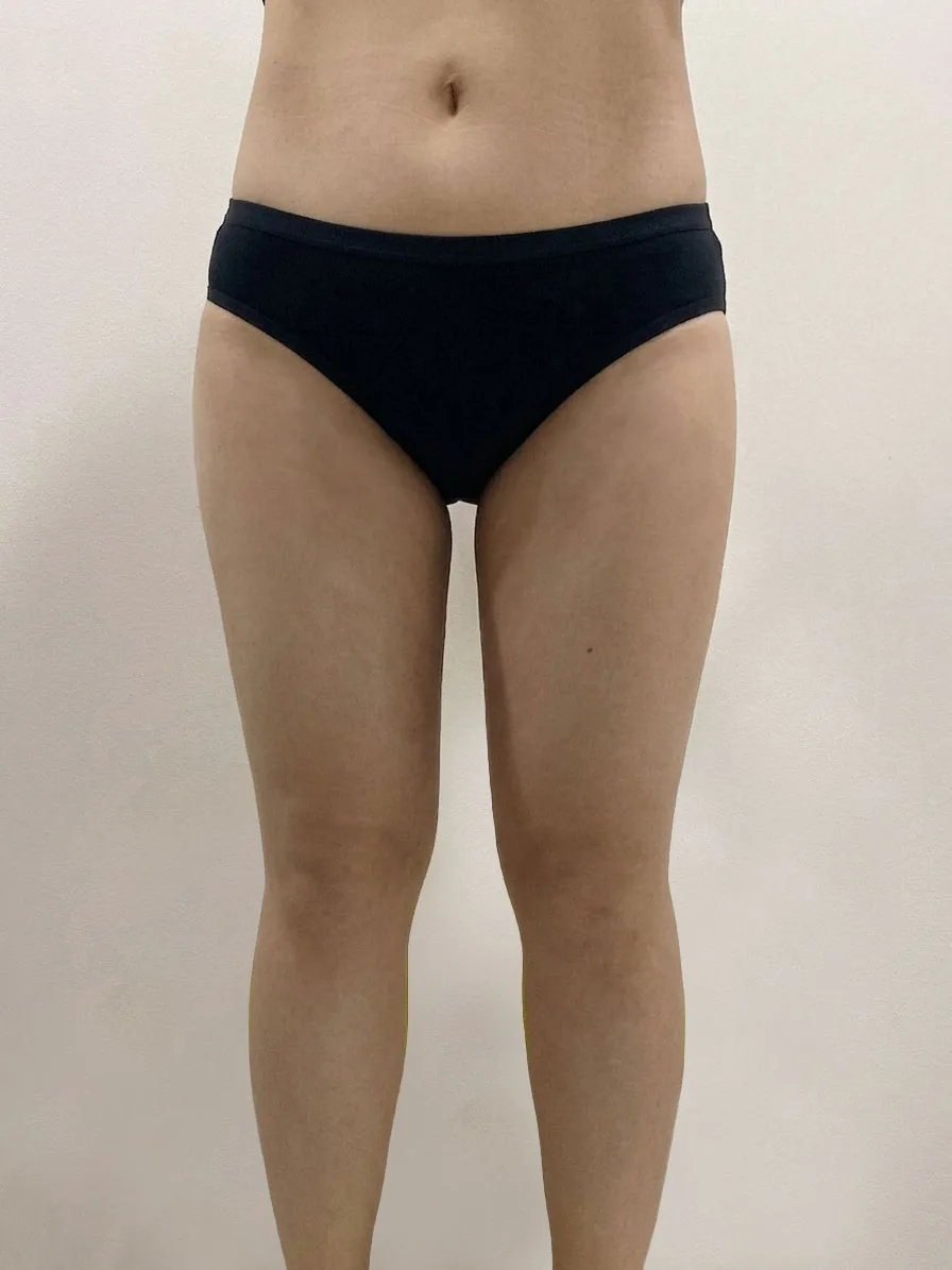 G-fat inner thigh lipolysis after, G Clinic Gangnam case 07