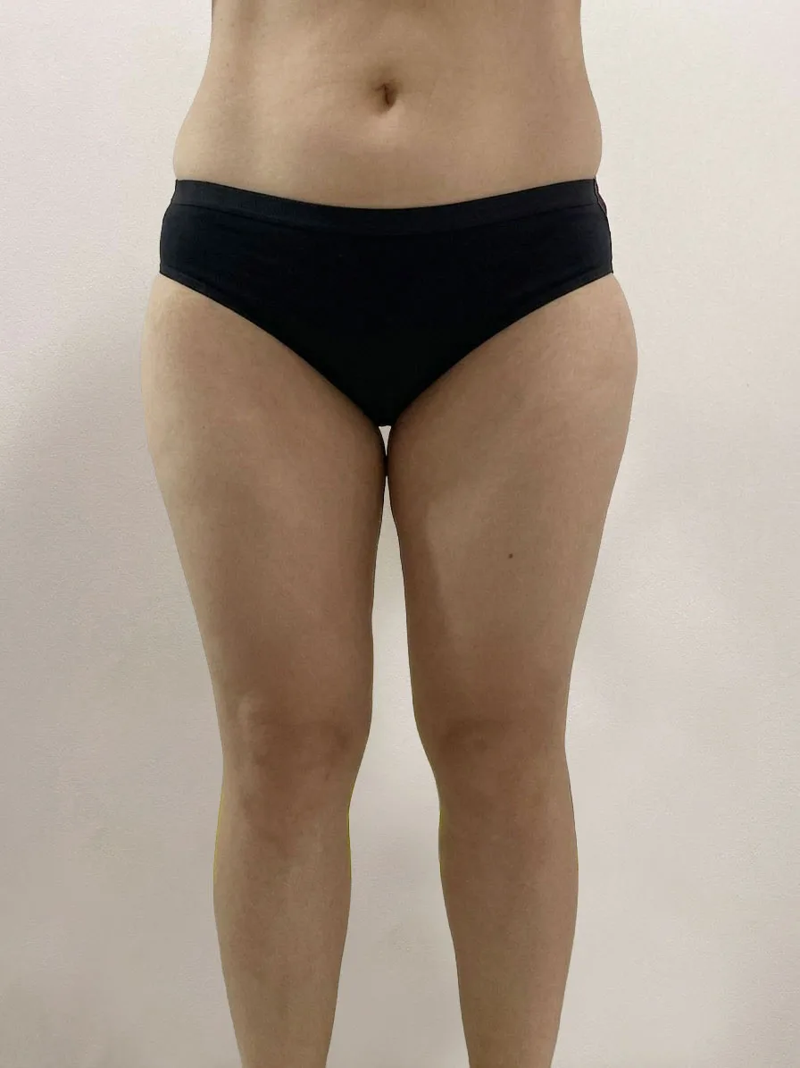 G-fat inner thigh lipolysis before, G Clinic Gangnam case 07