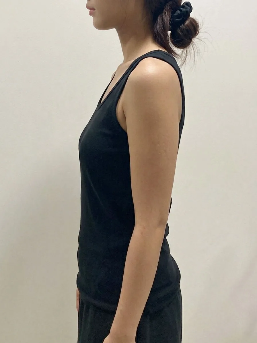 G-fat arm lipolysis after, G Clinic Gangnam case 08
