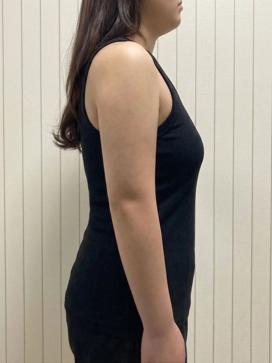 G-fat arm lipolysis after, G Clinic Gangnam case 09