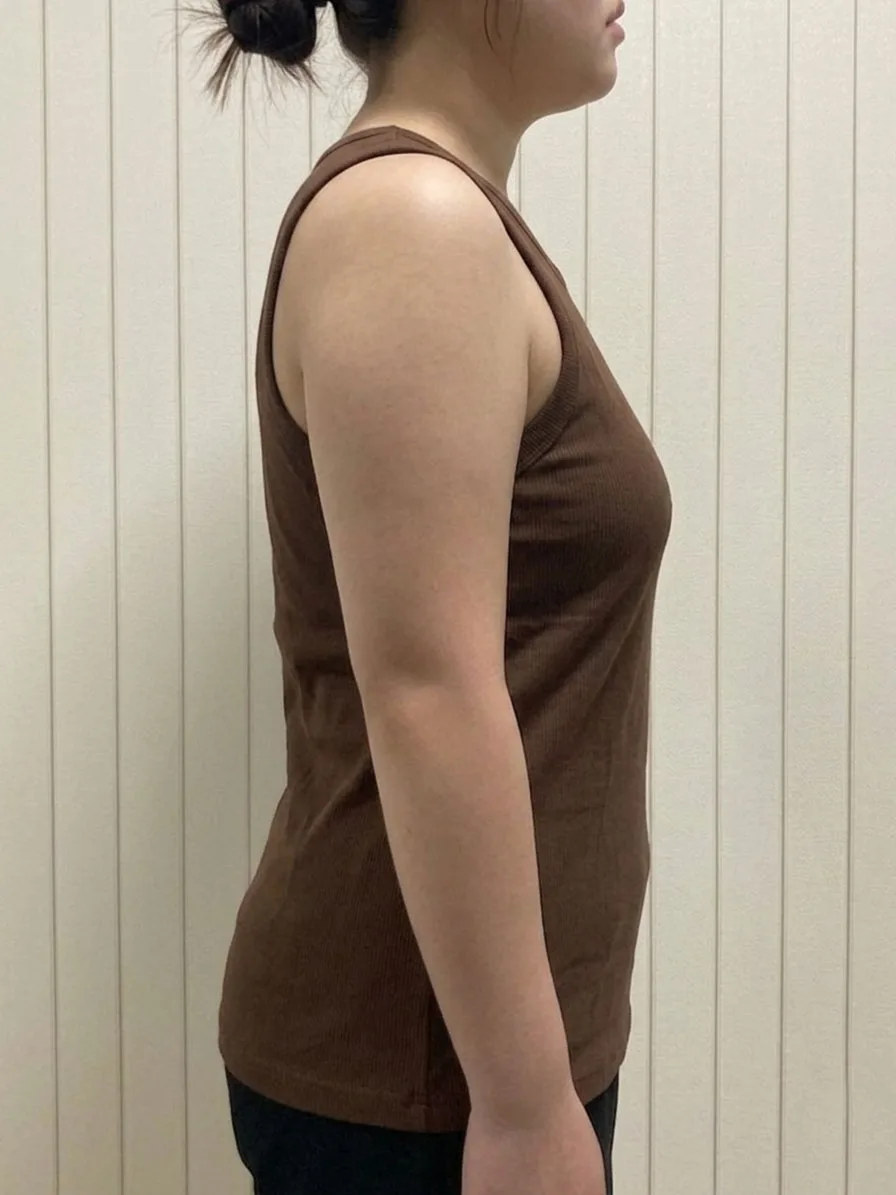 G-fat arm lipolysis before, G Clinic Gangnam case 09