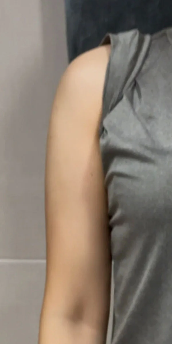 G-fat upper arm lipolysis after, G Clinic Gangnam case 10