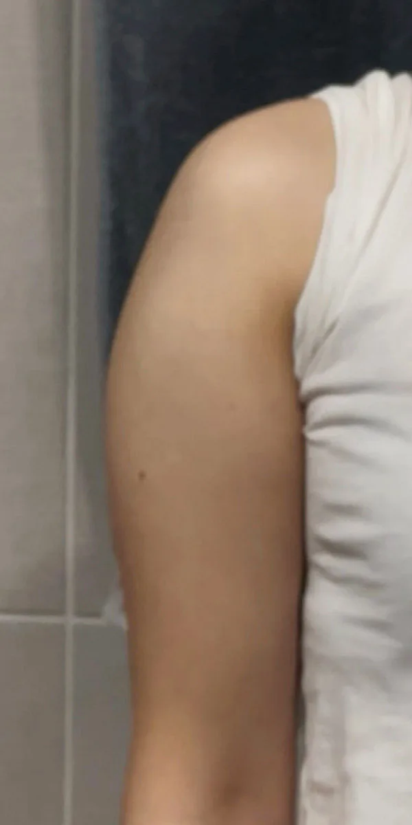 G-fat upper arm lipolysis before, G Clinic Gangnam case 10