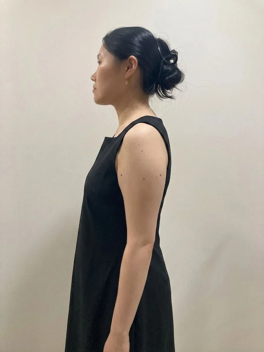 G-fat arm lipolysis after, G Clinic Gangnam case 15
