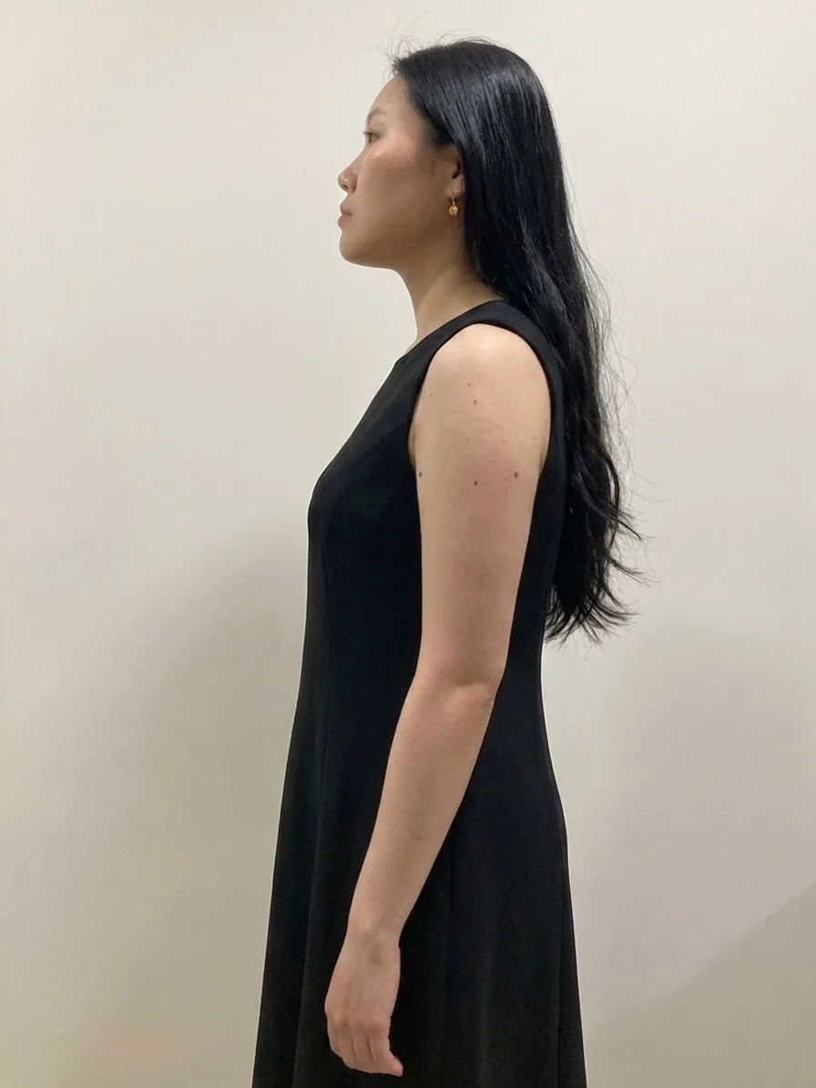 G-fat arm lipolysis before, G Clinic Gangnam case 15