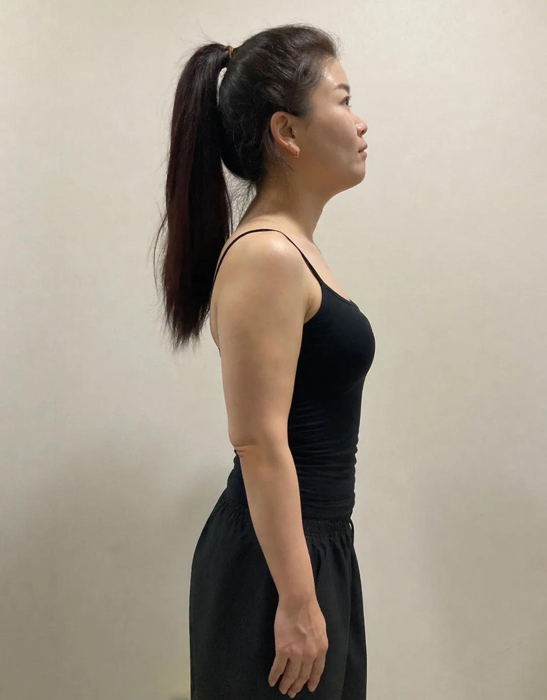 G-fat arm lipolysis after, G Clinic Gangnam case 16