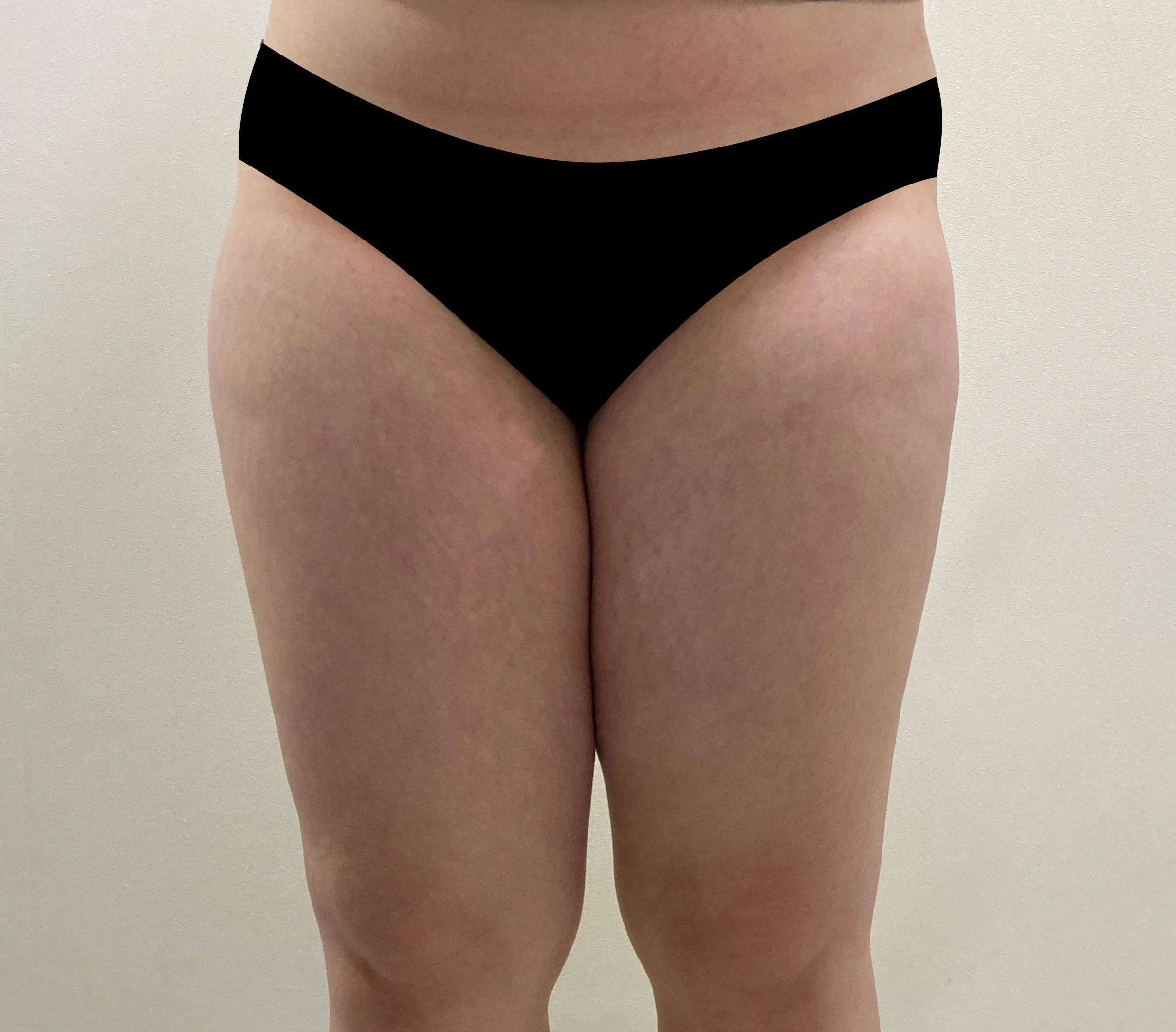 G-fat inner thigh lipolysis before, G Clinic Gangnam case 21