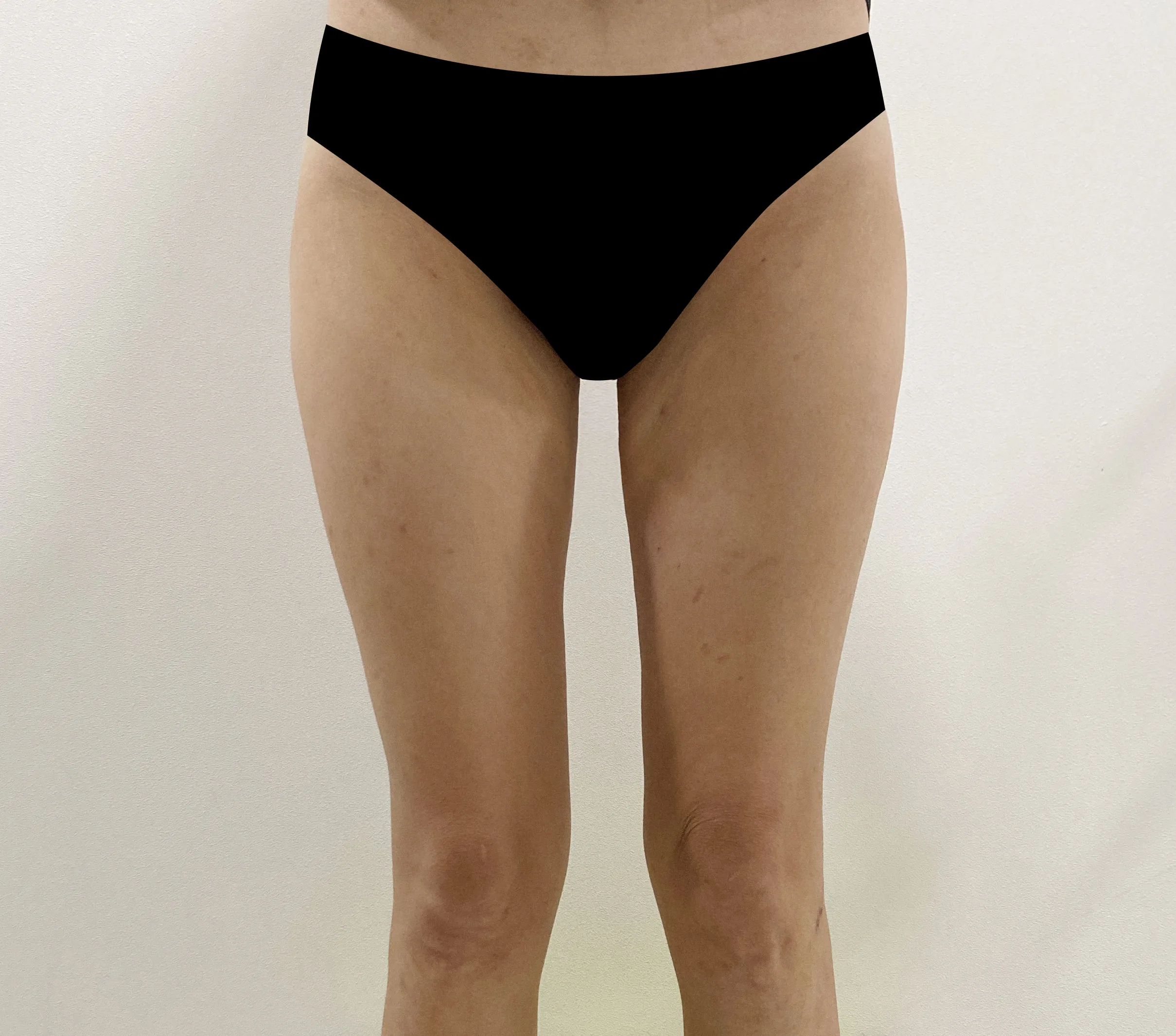 G-fat inner thigh lipolysis after, G Clinic Gangnam case 26