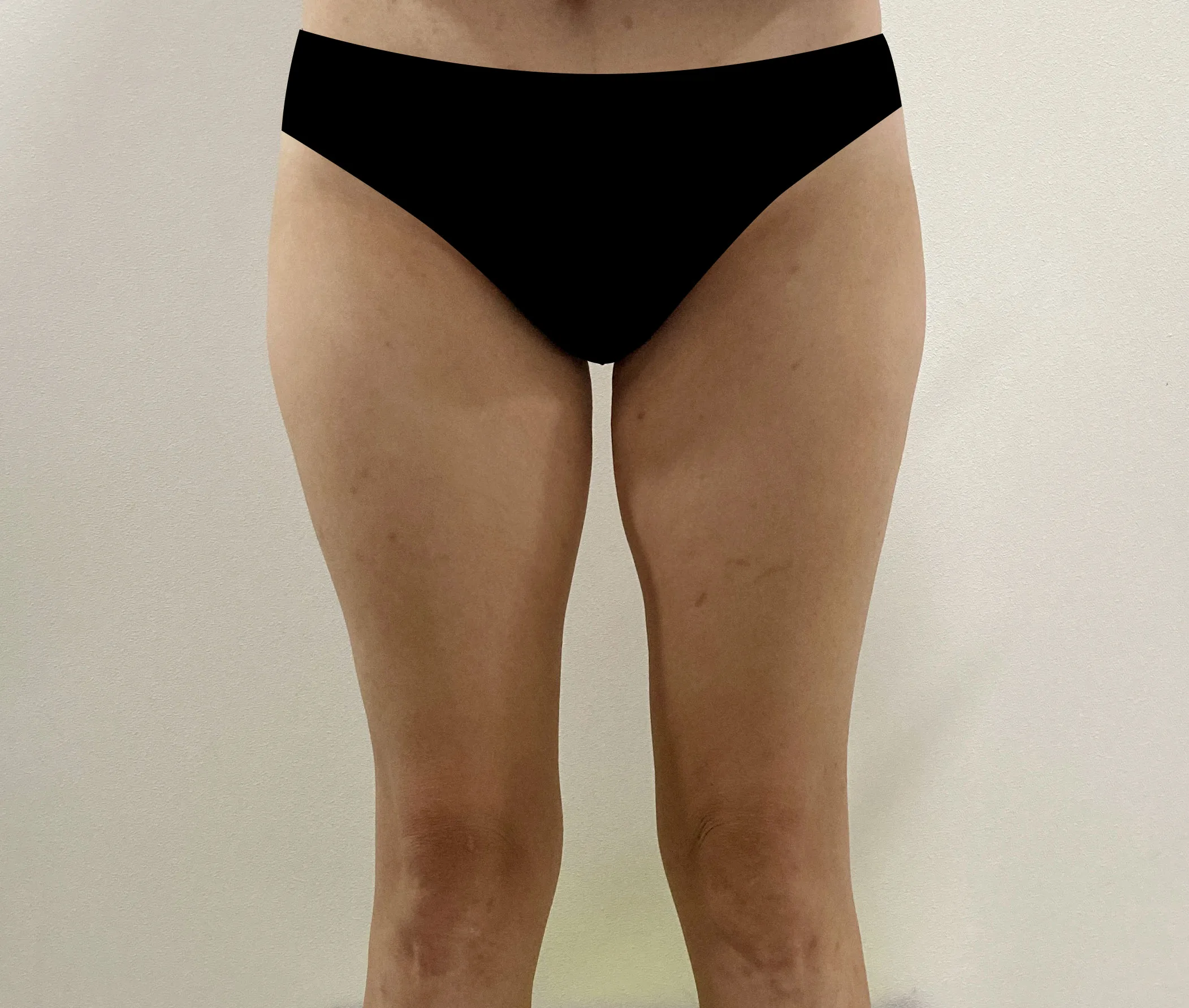 G-fat inner thigh lipolysis before, G Clinic Gangnam case 26