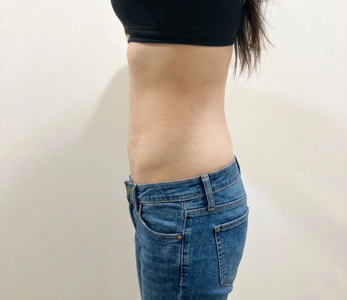 G-fat abdomen lipolysis after, G Clinic Gangnam case 29