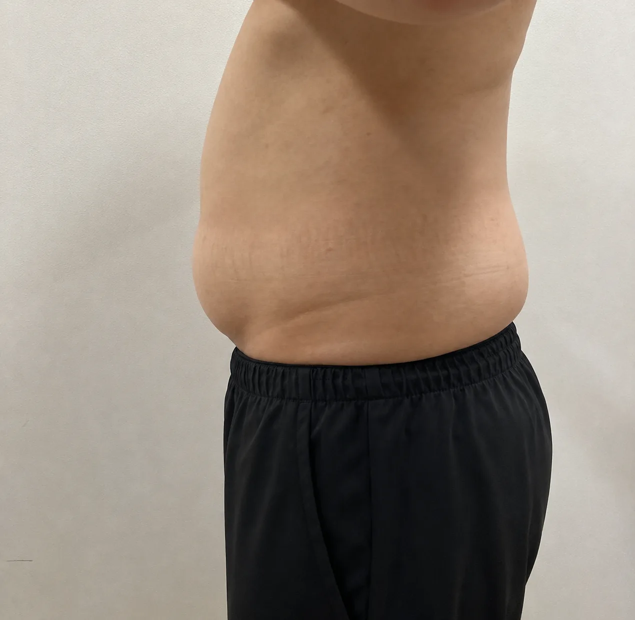 G-fat abdomen lipolysis before, G Clinic Gangnam case 29