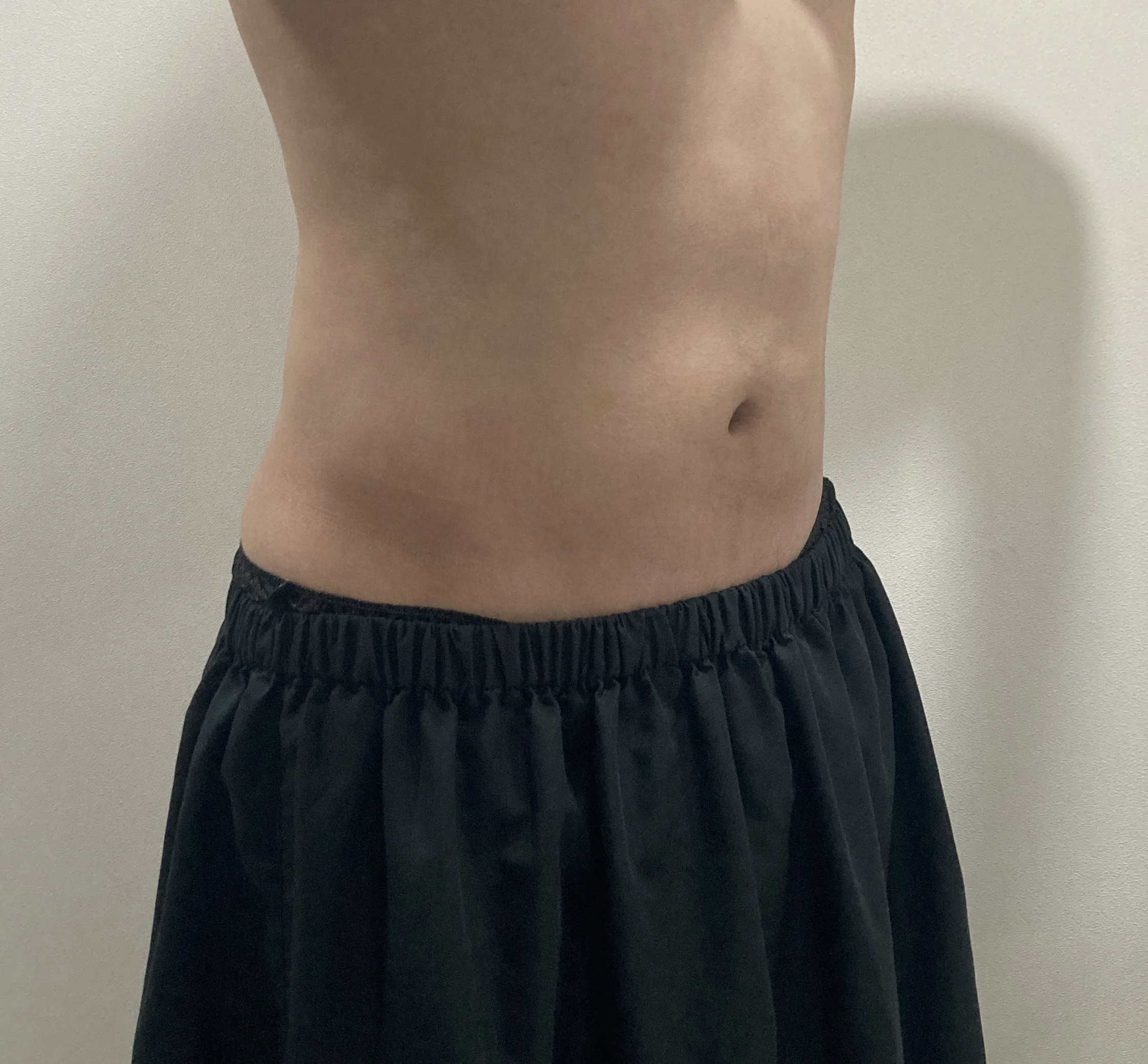 Abdomen after G-fat fat dissolving injection, case 37