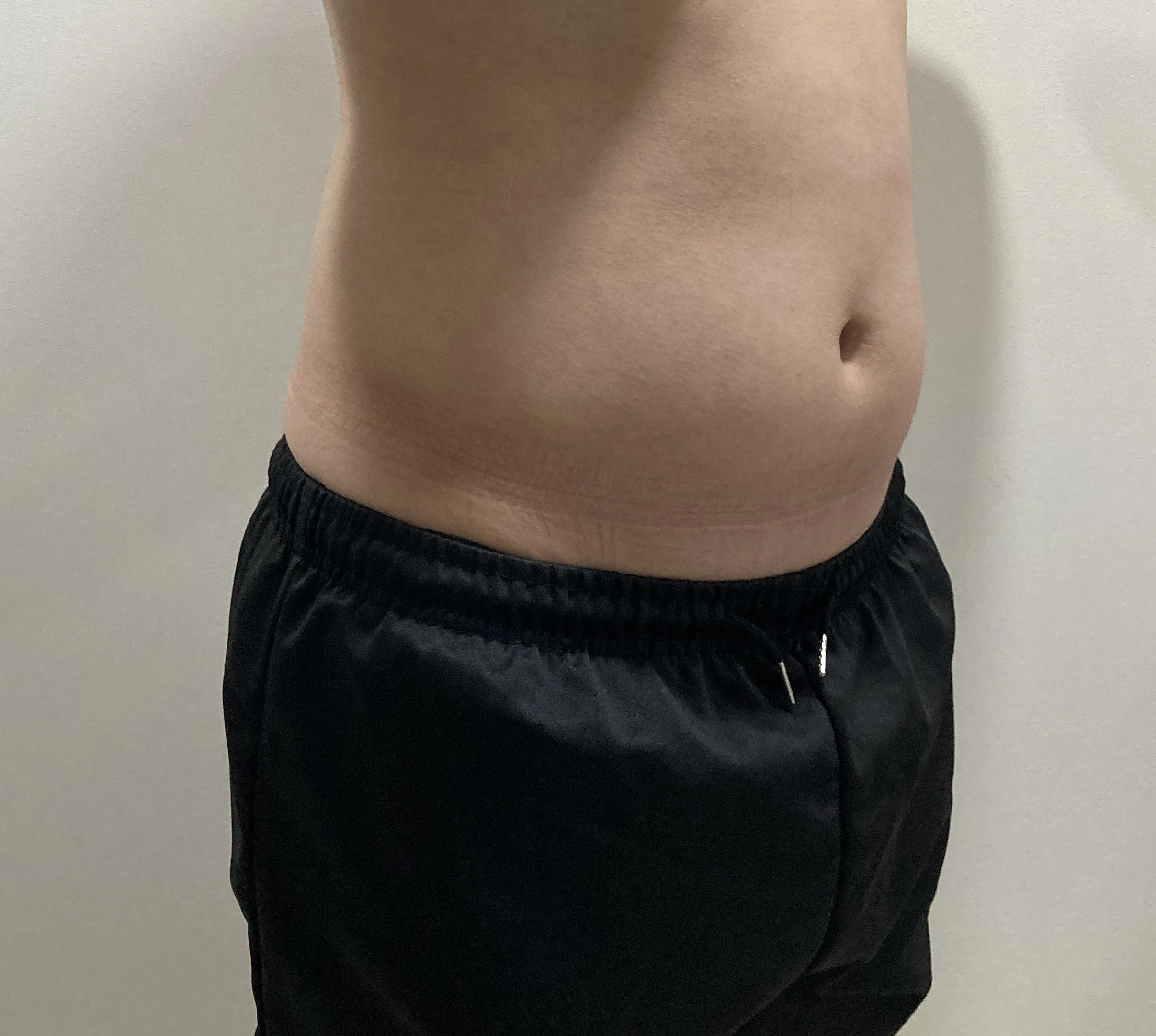 Abdomen before G-fat fat dissolving injection, case 37