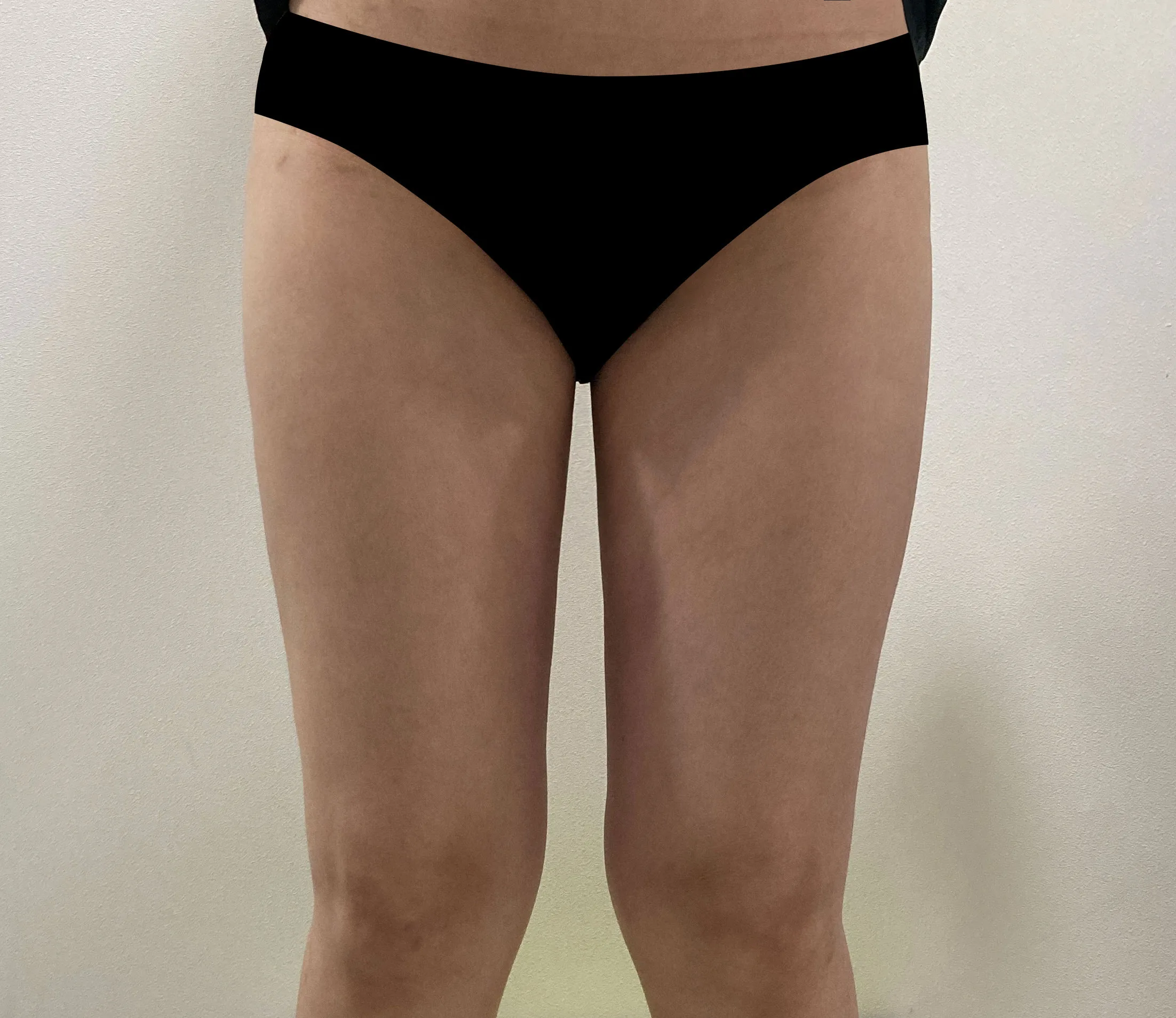 G-fat inner thigh lipolysis after, G Clinic Gangnam case 43