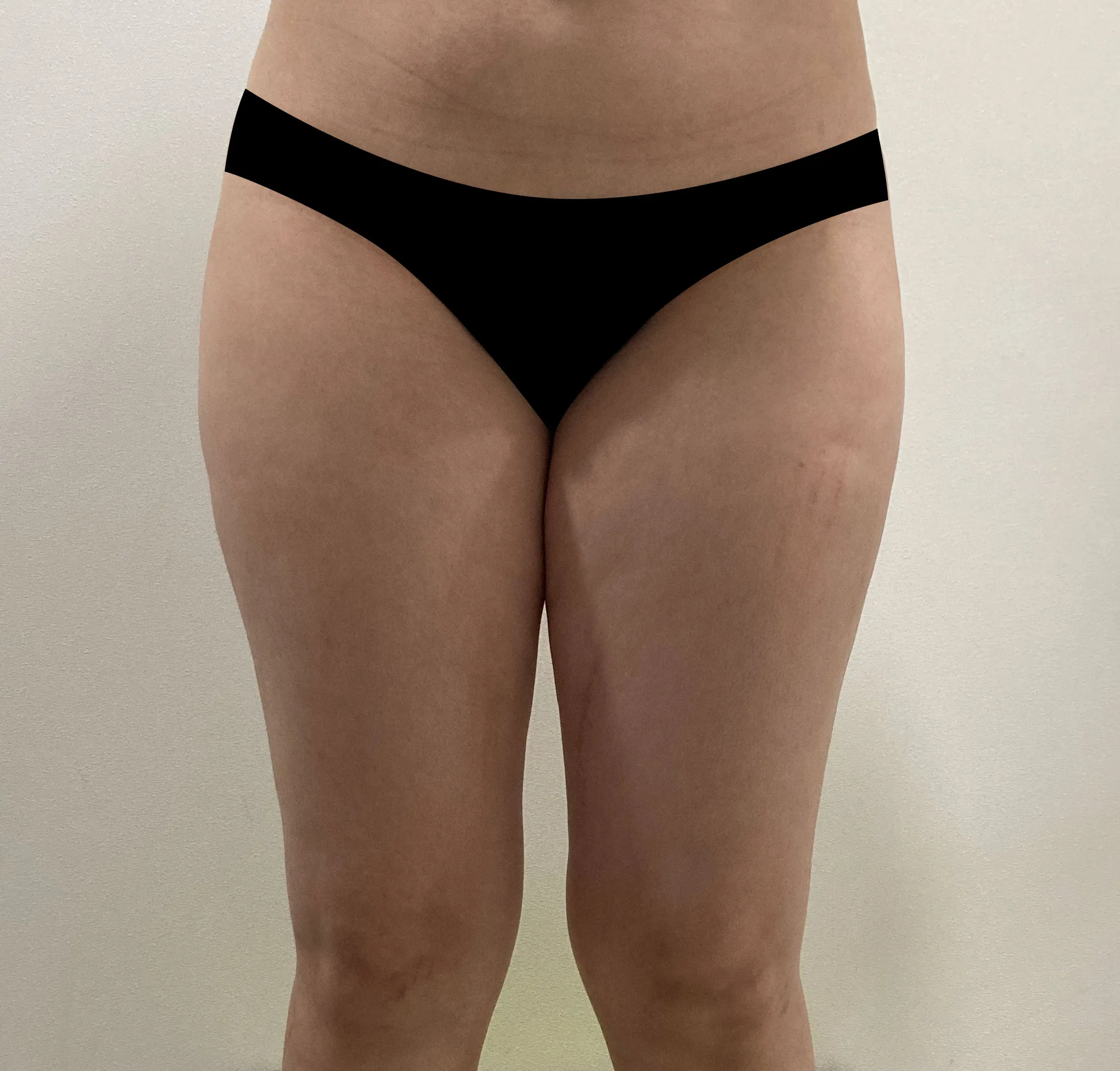 G-fat inner thigh lipolysis before, G Clinic Gangnam case 43