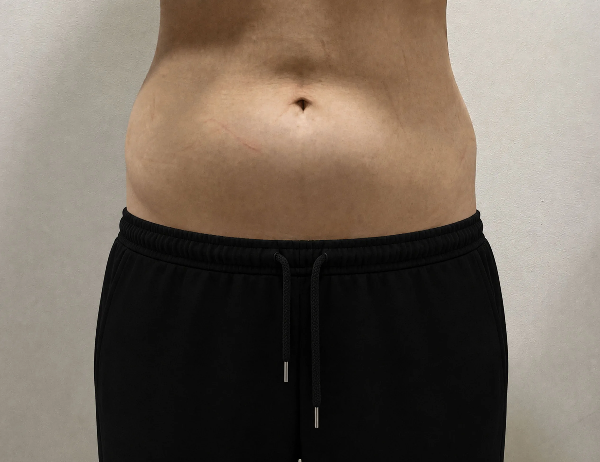 G-fat abdomen lipolysis after, G Clinic Gangnam case 44