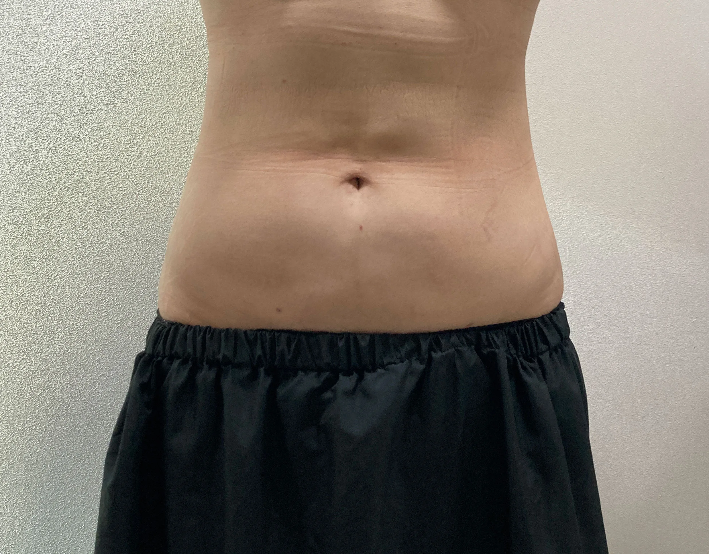 G-fat abdomen lipolysis before, G Clinic Gangnam case 44