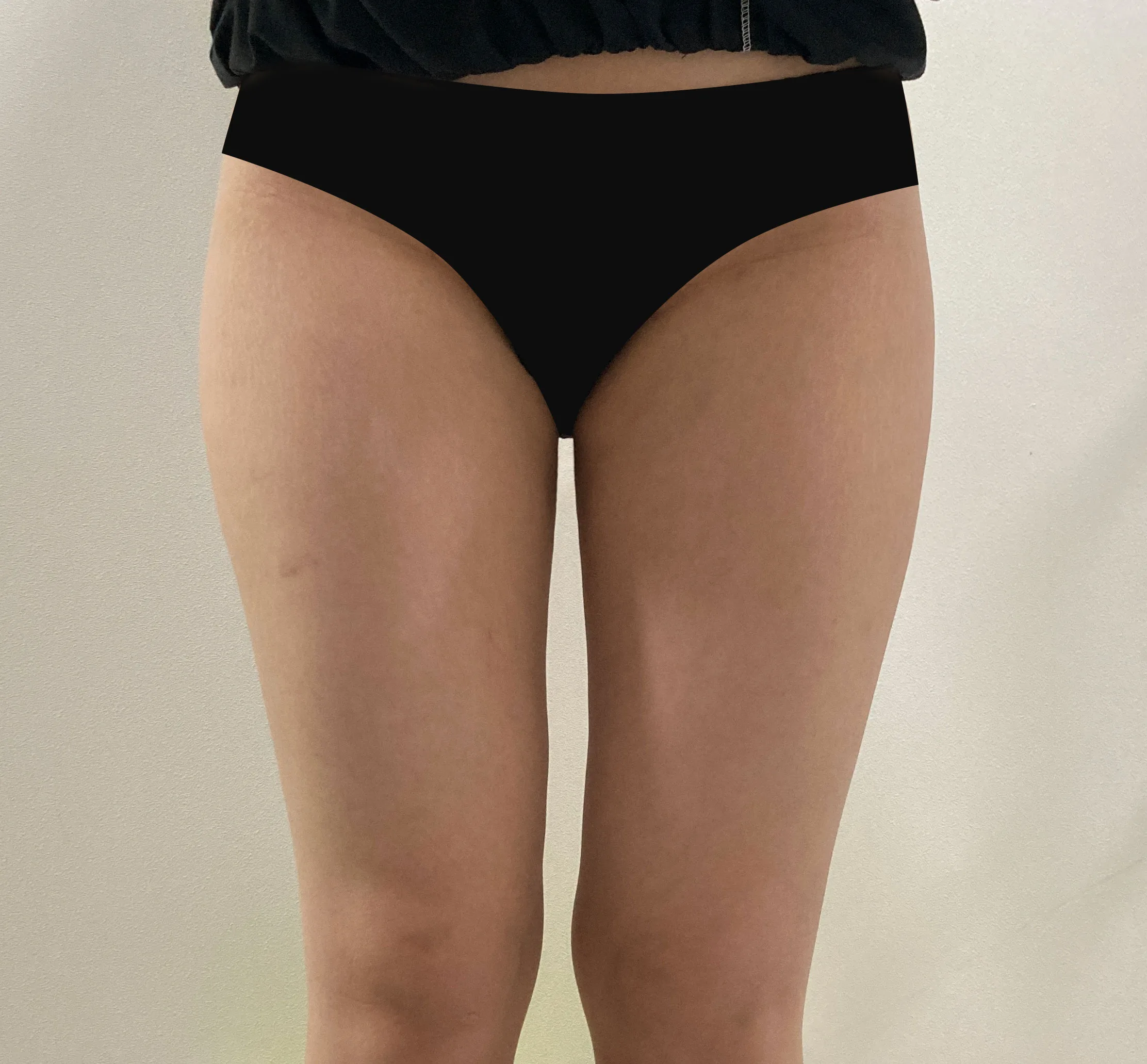 G-fat thigh lipolysis after, G Clinic Gangnam case 58