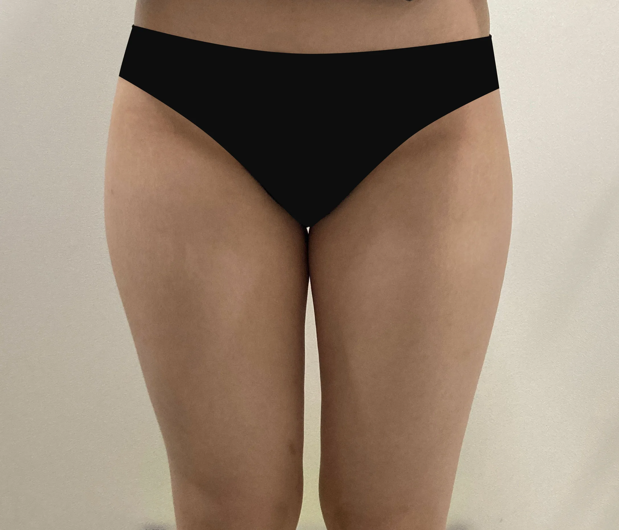 G-fat thigh lipolysis before, G Clinic Gangnam case 58