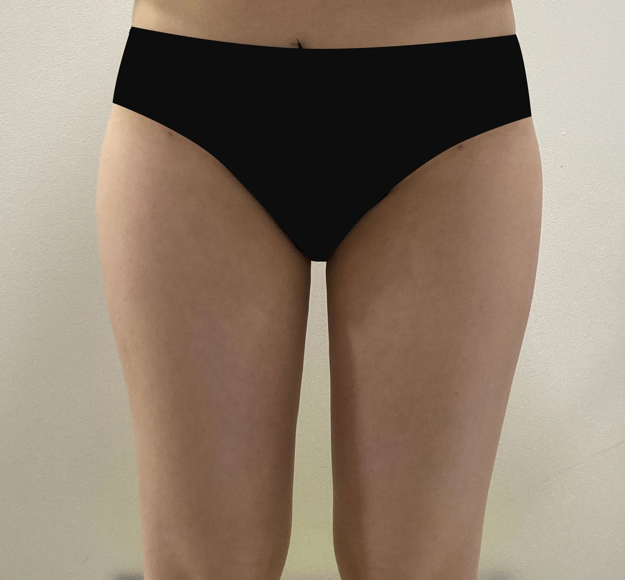 G-fat thigh lipolysis after, G Clinic Gangnam case 59