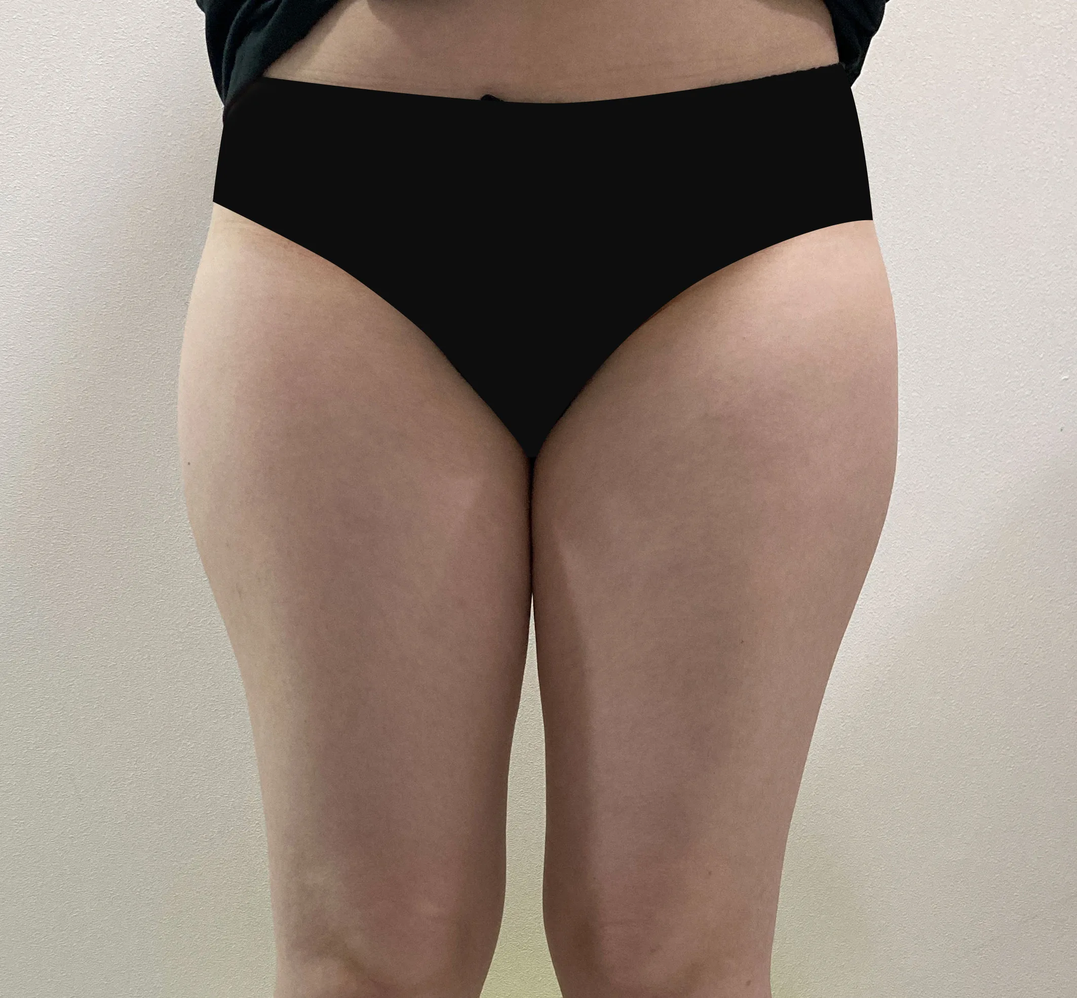 G-fat thigh lipolysis before, G Clinic Gangnam case 59