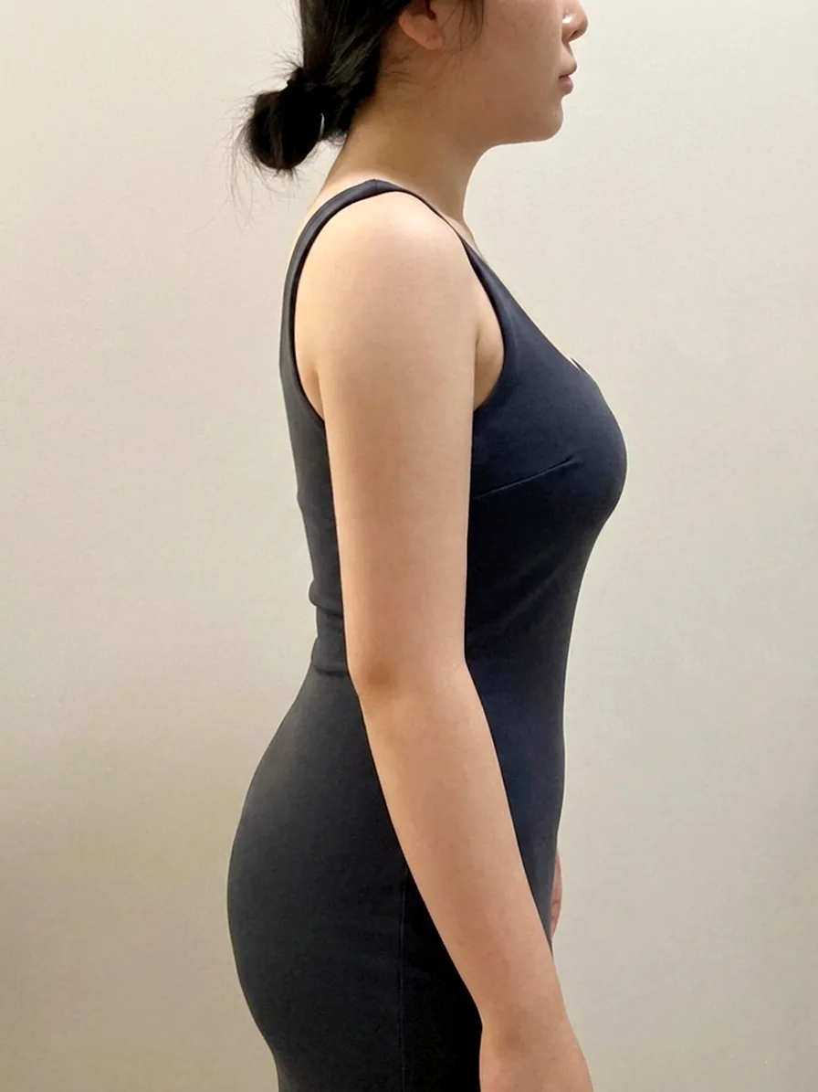 G-fat upper arm extraction after, G Clinic Gangnam case 03