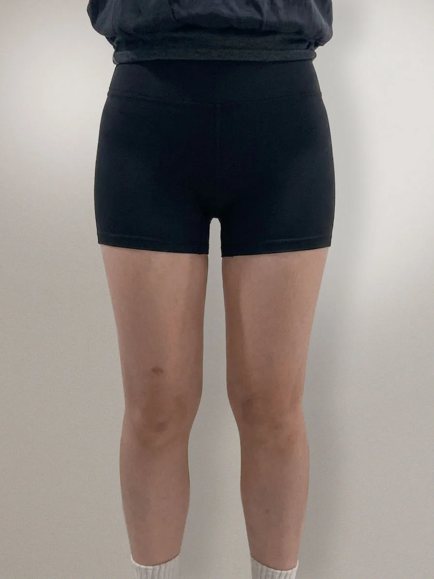 G-fat inner thigh extraction after, G Clinic Gangnam case 04