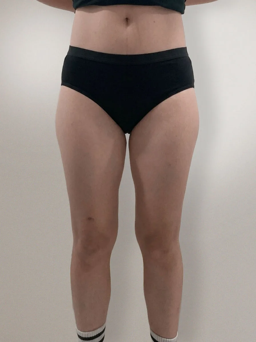 G-fat inner thigh extraction before, G Clinic Gangnam case 04