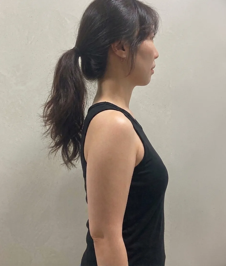 G-fat upper arm extraction before, G Clinic Gangnam case 05