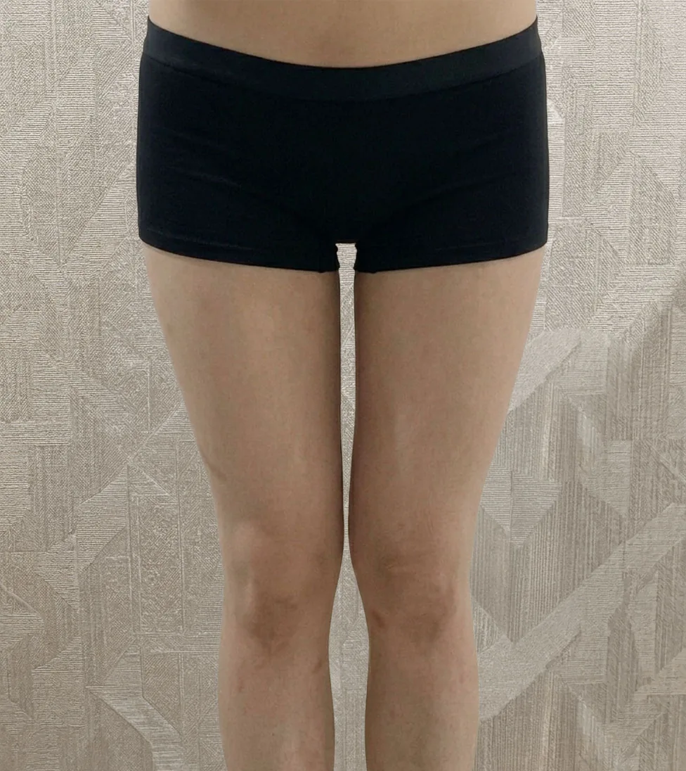 G-fat inner thigh extraction after, G Clinic Gangnam case 06