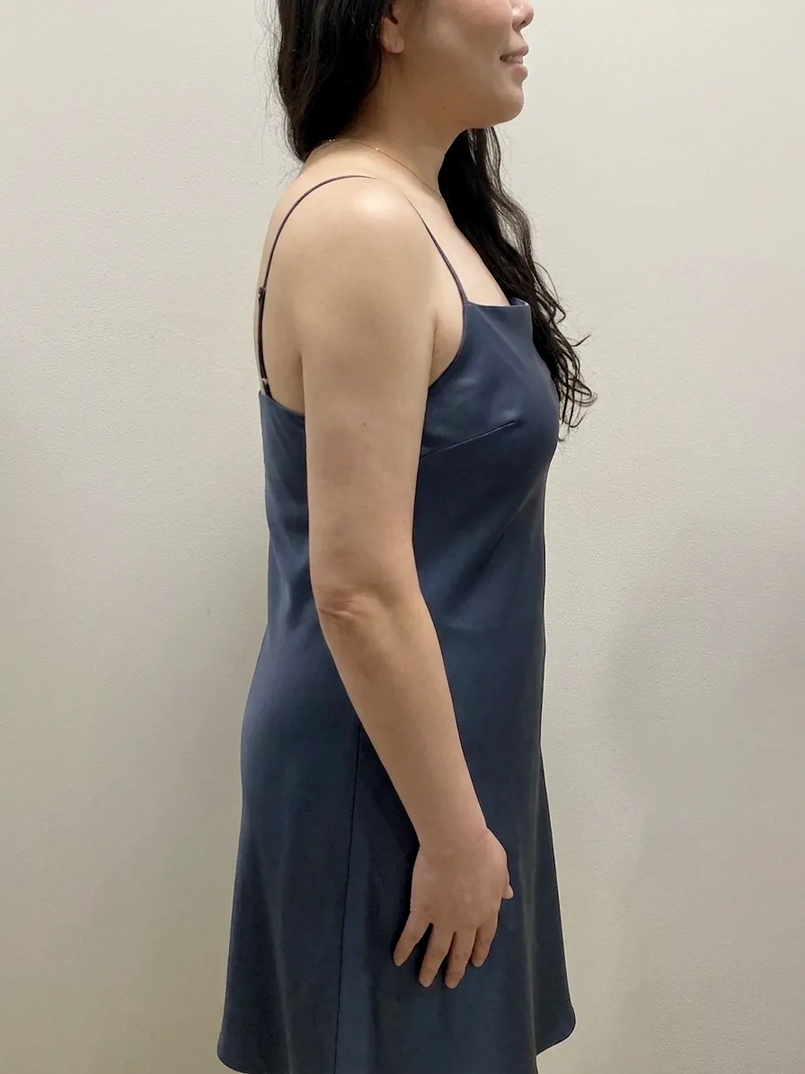 G-fat arm extraction after, G Clinic Gangnam case 12