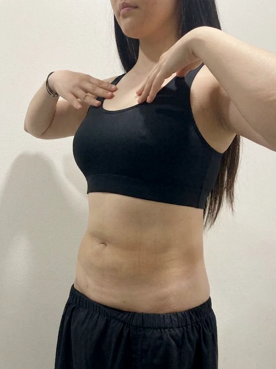 G-fat abdomen extraction after, G Clinic Gangnam case 14