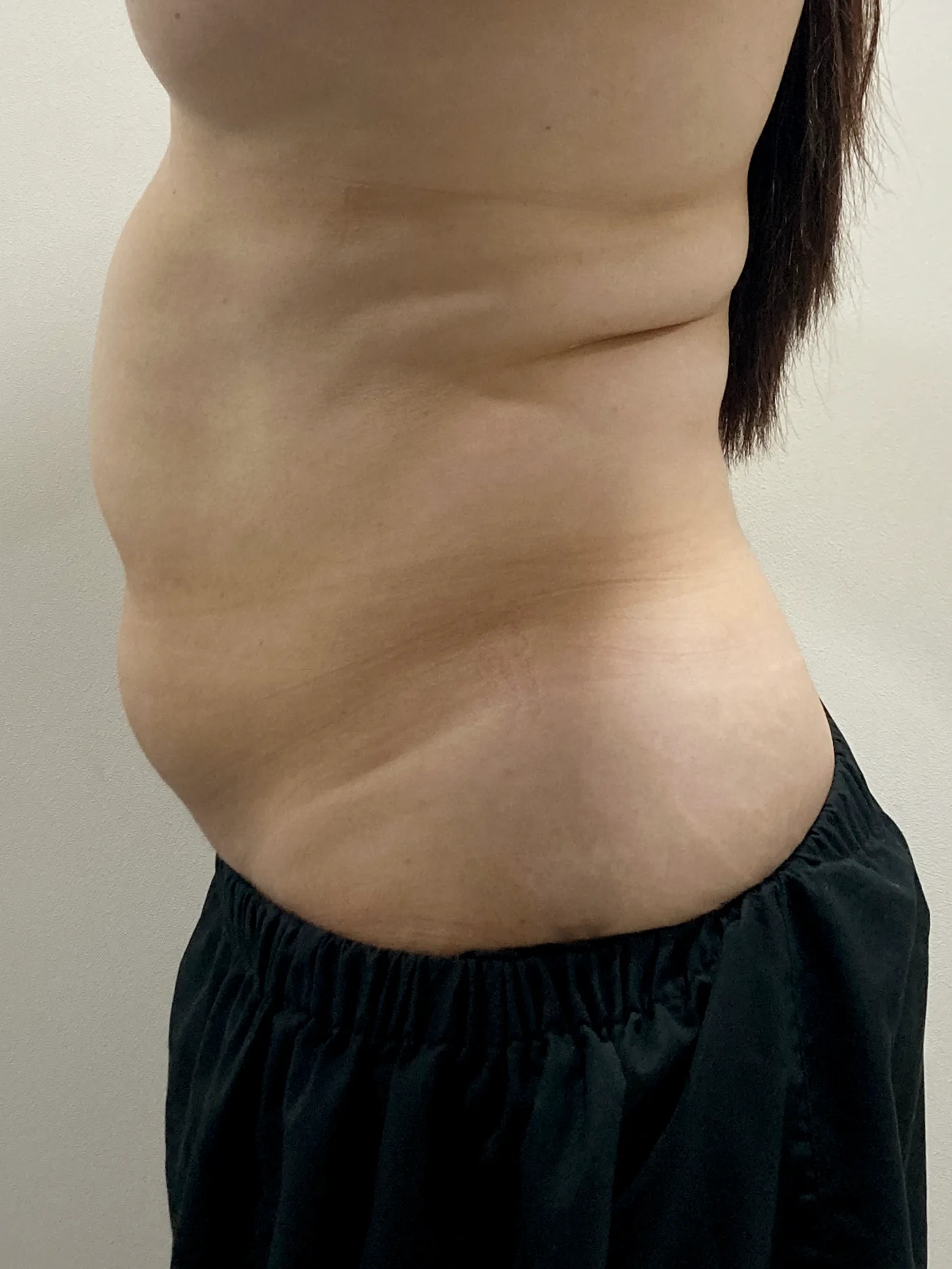 G-fat abdomen extraction before, G Clinic Gangnam case 14