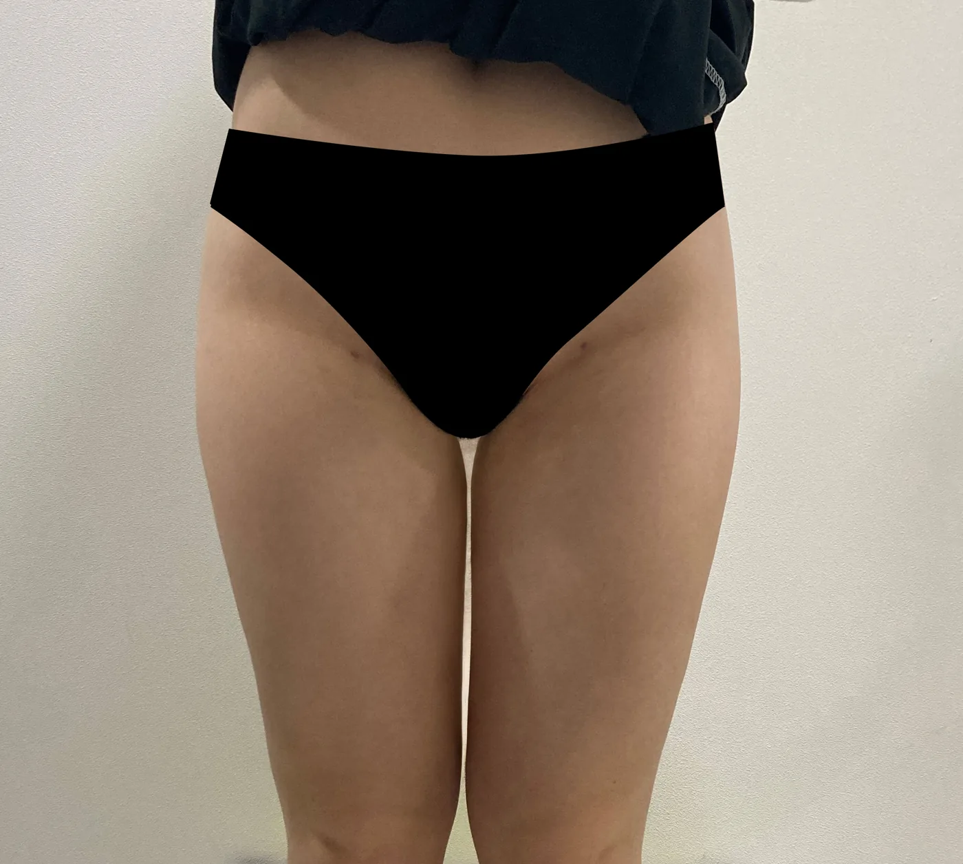 Inner thigh G-fat after, clinic-reported case