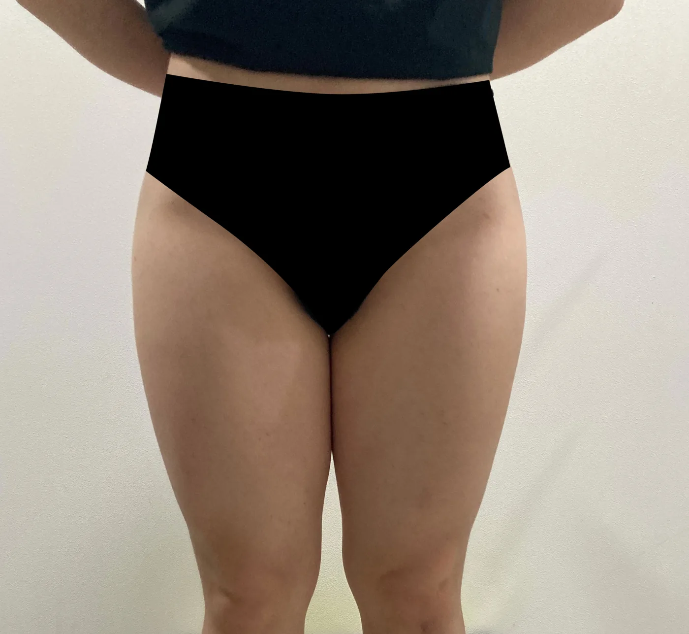 Inner thigh G-fat before, clinic-reported case