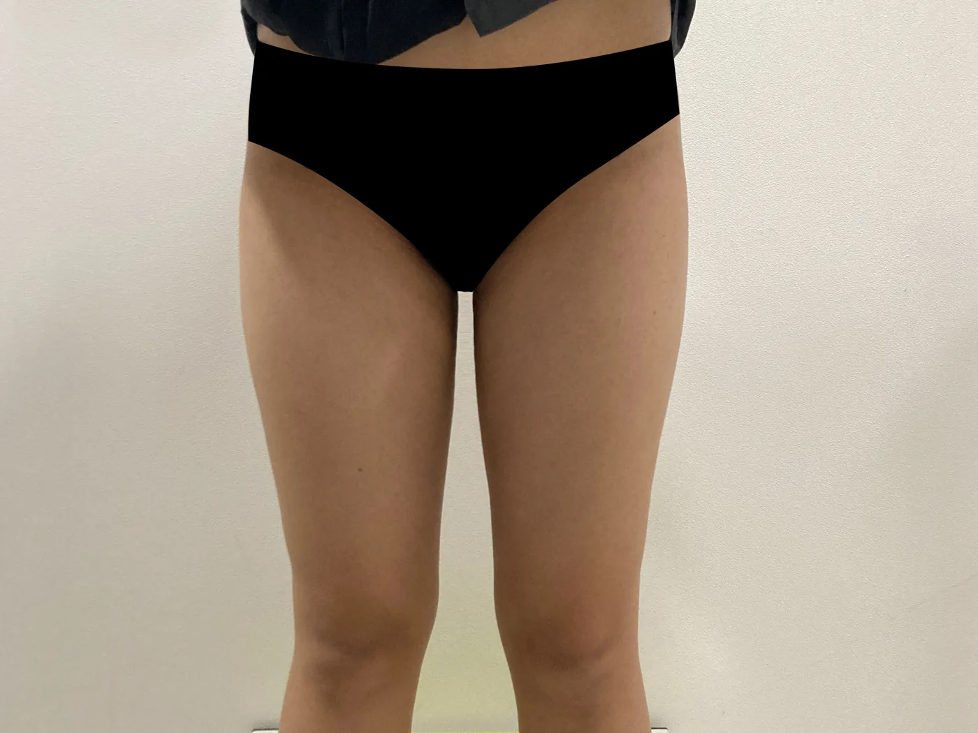 G-fat inner thigh extraction after, G Clinic Gangnam case 18