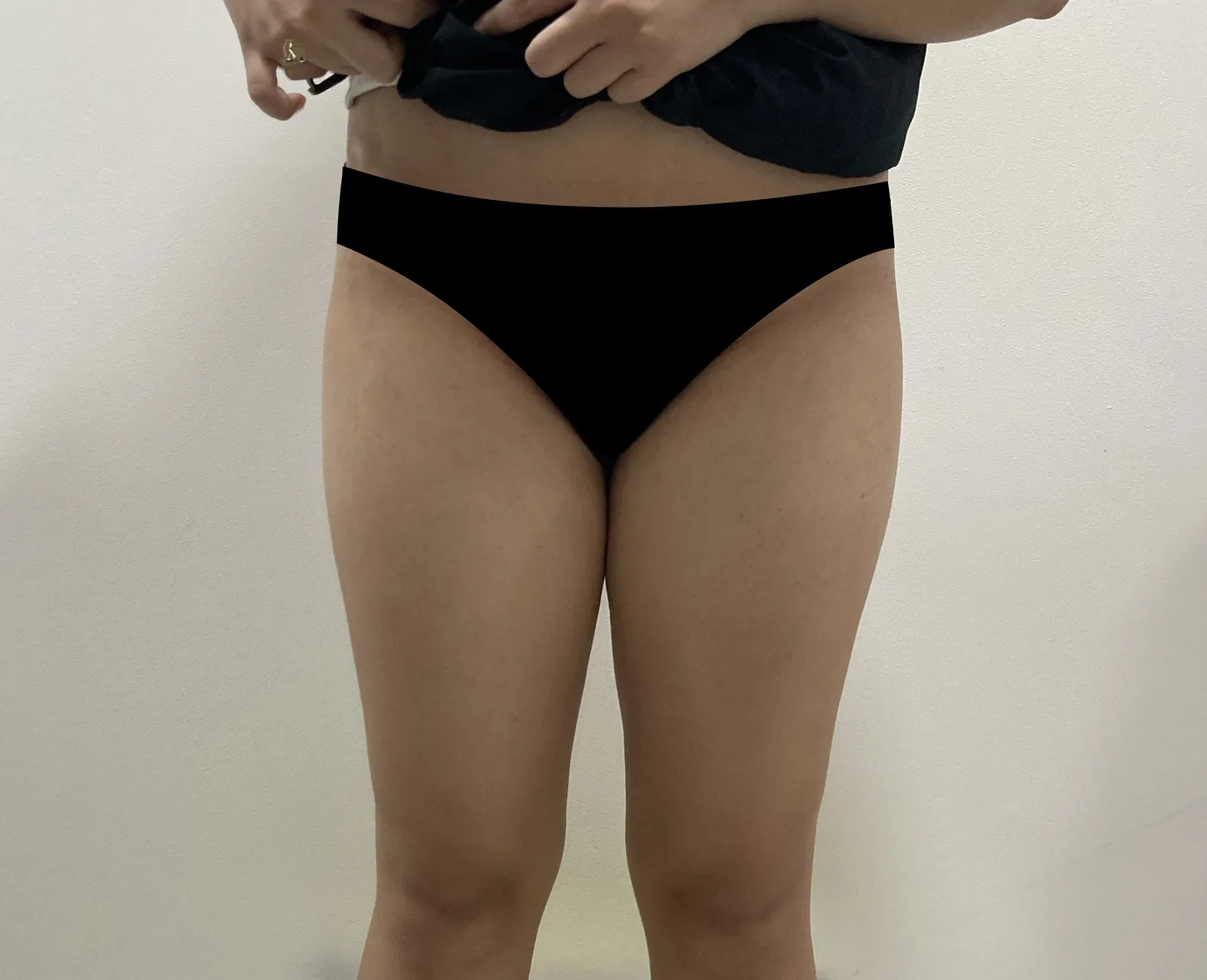 G-fat inner thigh extraction before, G Clinic Gangnam case 18