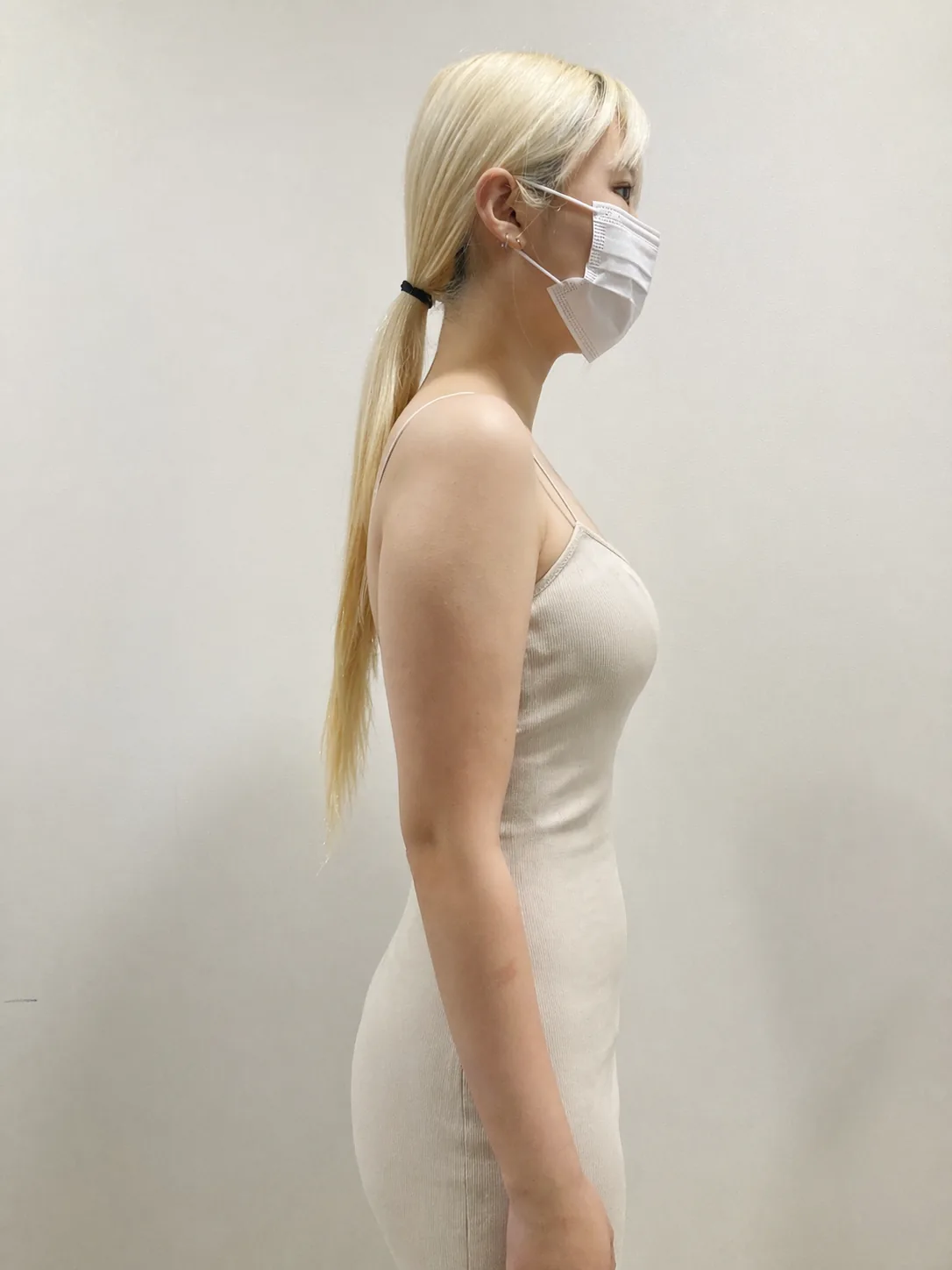 G-fat arm extraction before, G Clinic Gangnam case 20