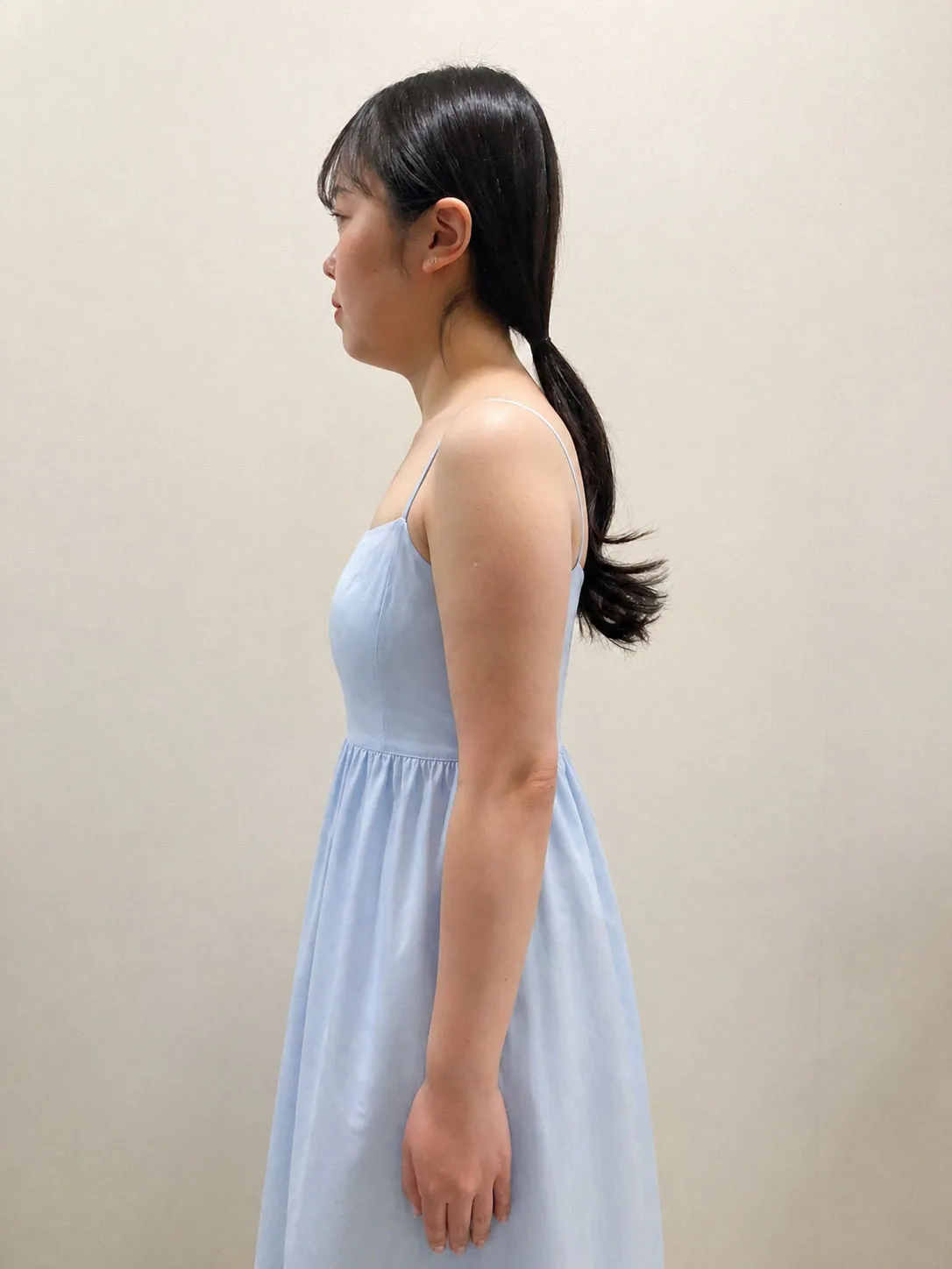G-fat arm extraction before, G Clinic Gangnam case 24