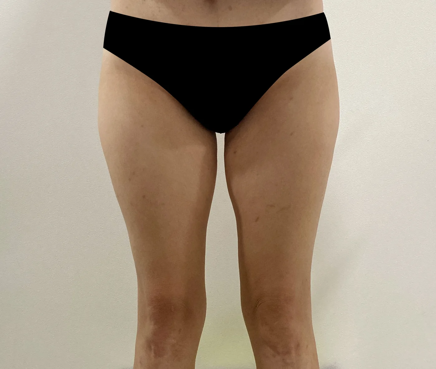 G-fat inner thigh extraction before, G Clinic Gangnam case 26