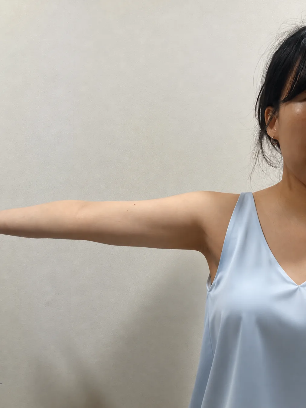 G-fat arm extraction after, G Clinic Gangnam case 27
