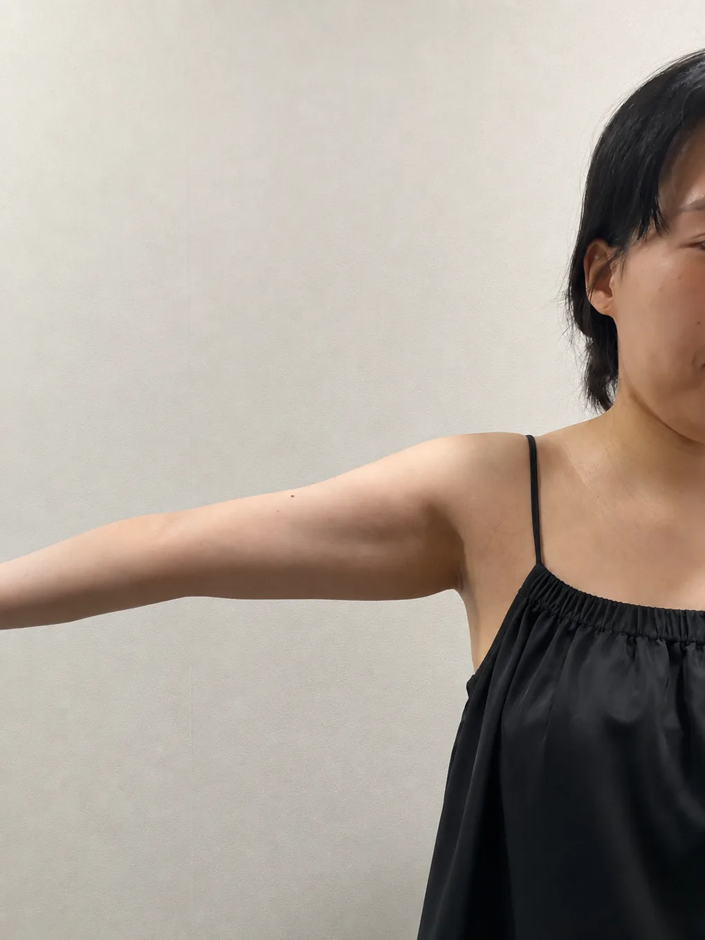 G-fat arm extraction before, G Clinic Gangnam case 27