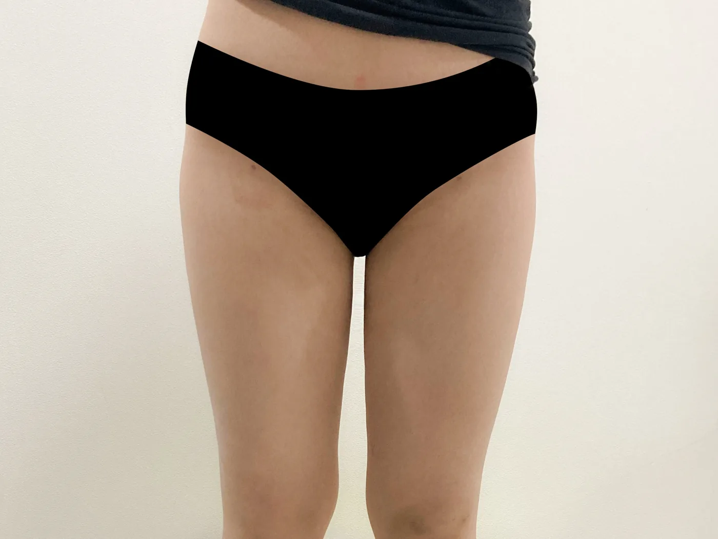 G-fat inner thigh extraction after, G Clinic Gangnam case 28