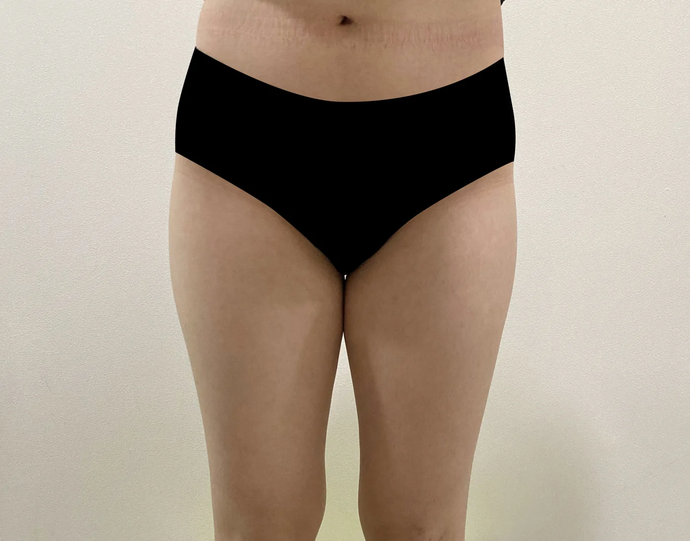 G-fat inner thigh extraction before, G Clinic Gangnam case 28